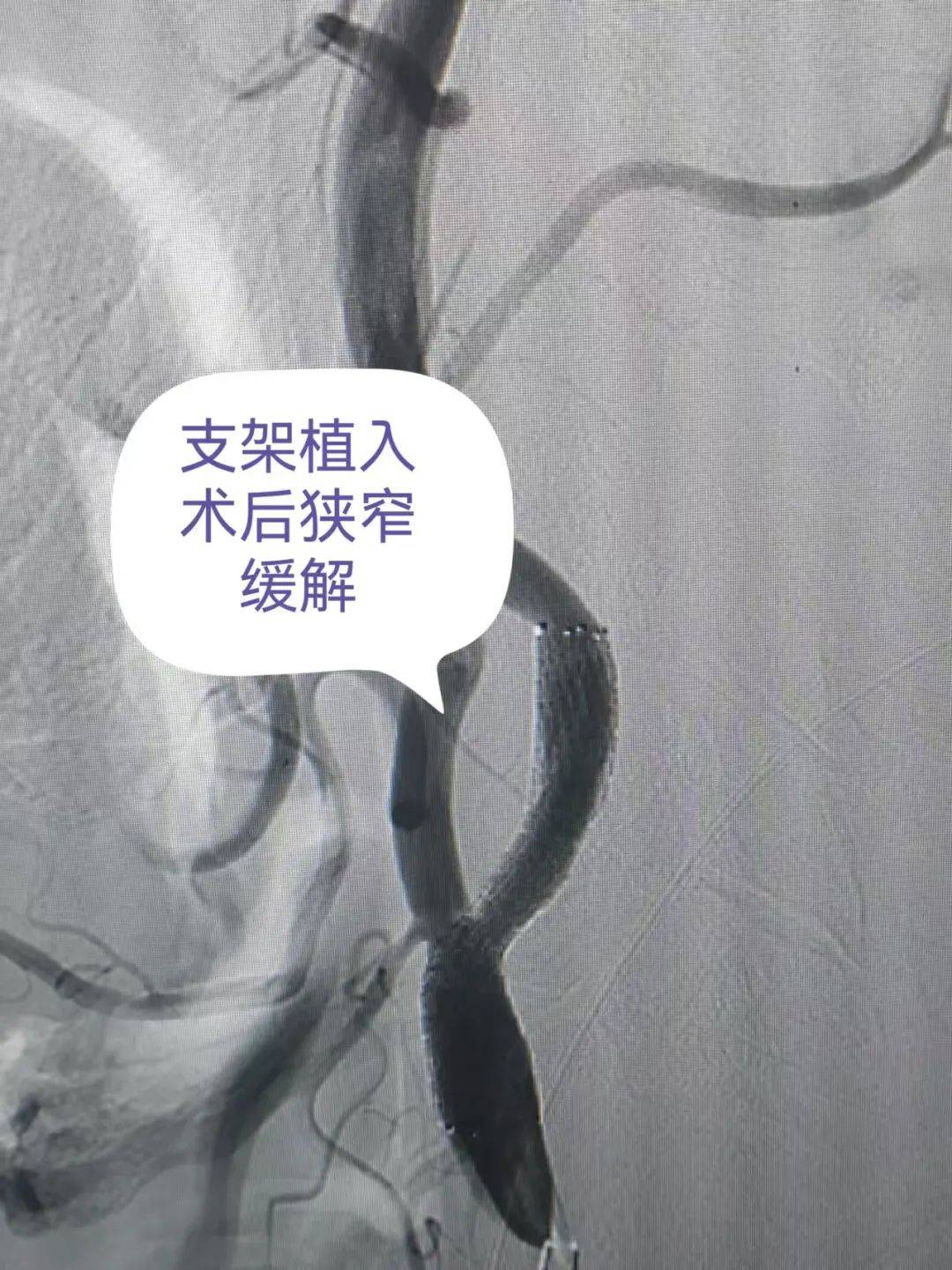 【团队风采】神经内科介入团队
