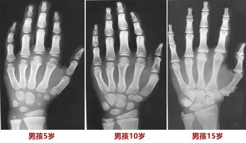 优雅的骨龄发展快什么原因的图片