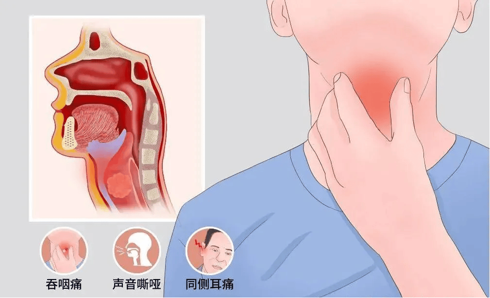 下咽癌位置图片