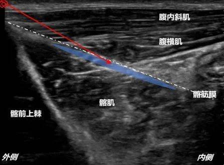 髂筋膜阻滞超声图ppt图片