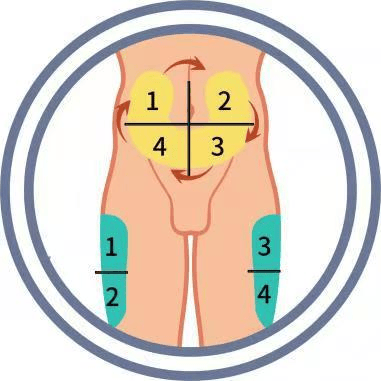 科普:妊娠期糖尿病,使用胰岛素该如何进行正确的注射?