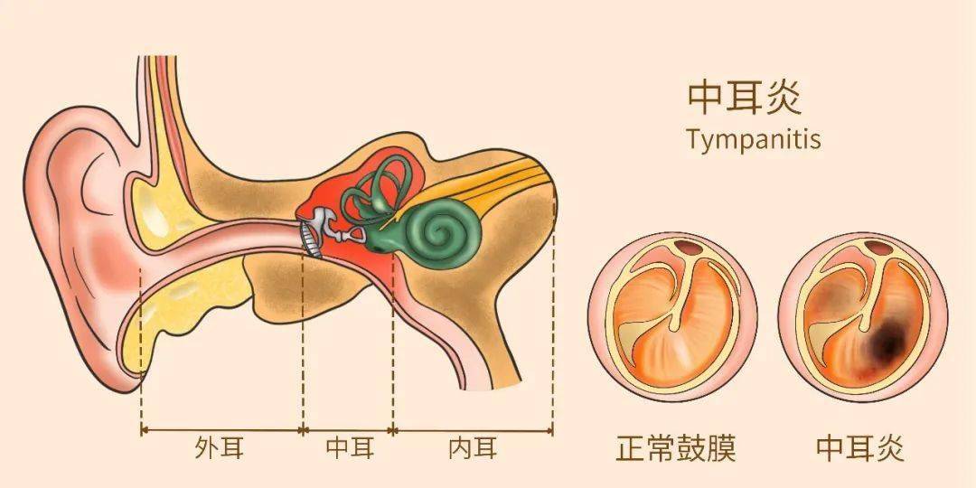 感冒后会有中耳炎?耳鼻喉科医生为您支招