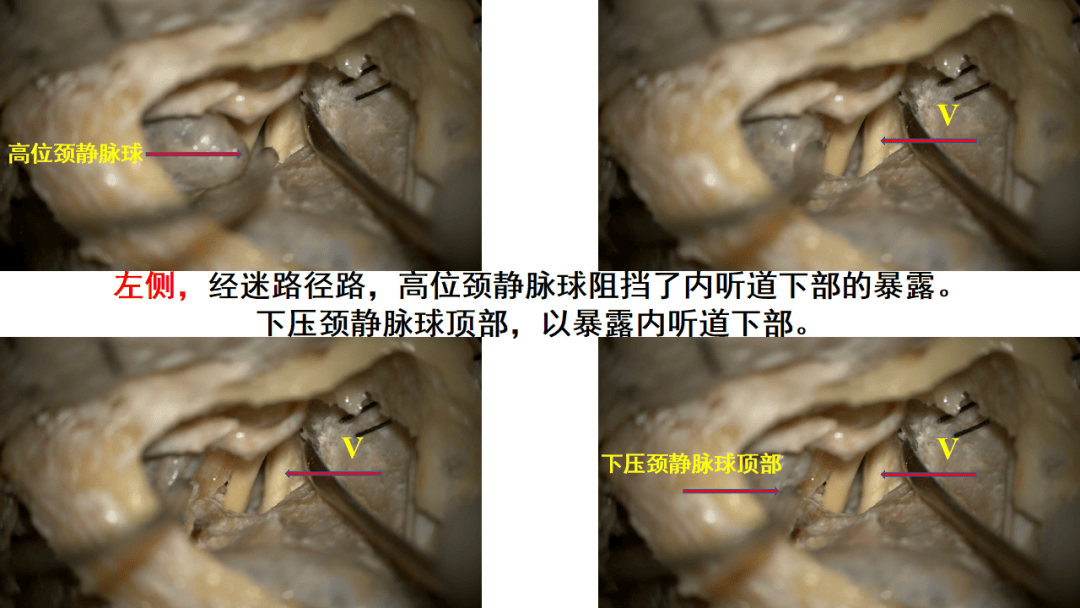 听神经瘤显微外科手术经典入路解剖培训班系列报导之二