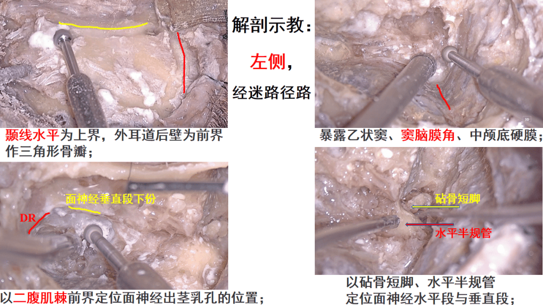 听神经瘤显微外科手术经典入路解剖培训班系列报导之二