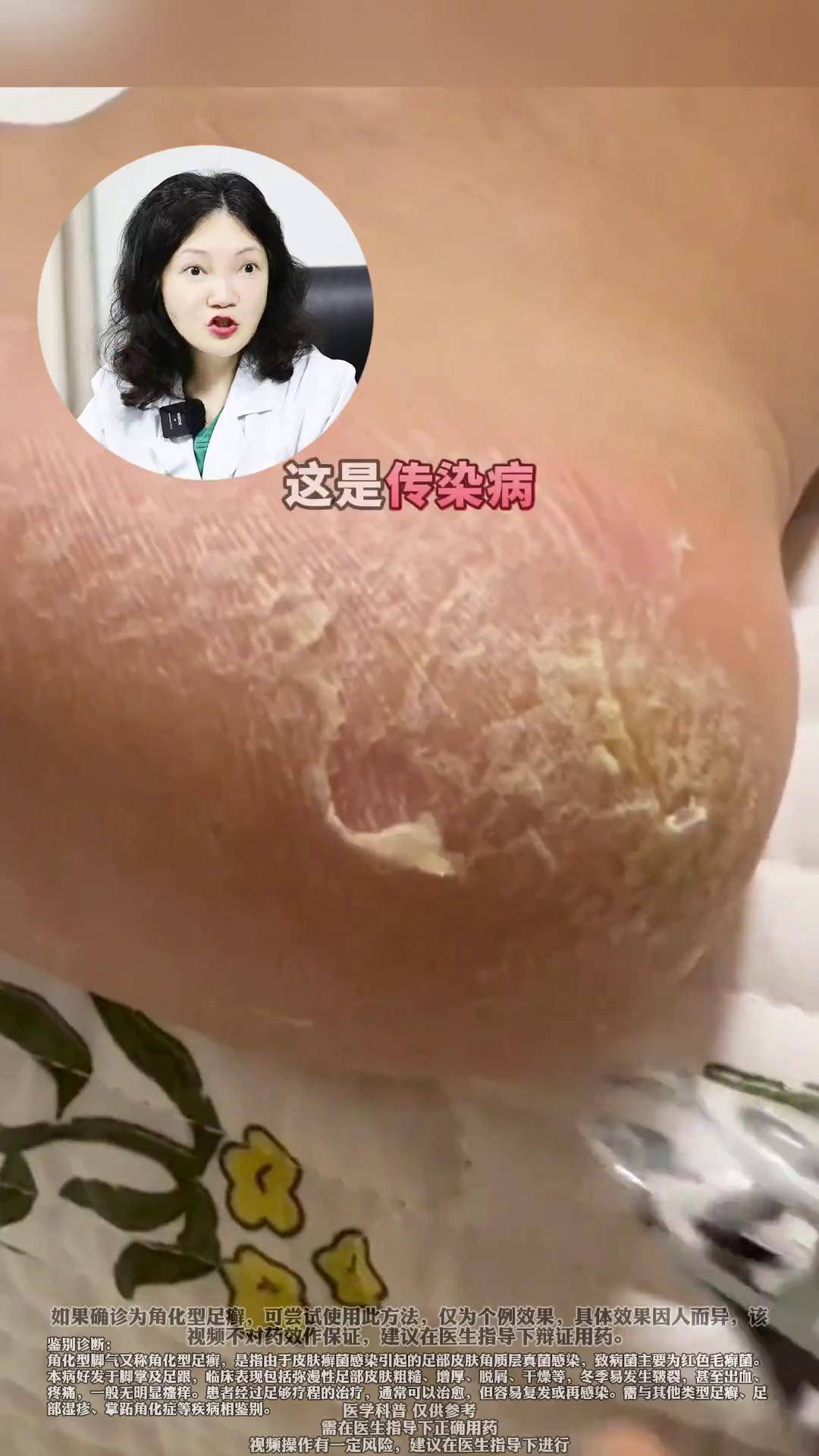 角化型脚气 脚后跟粗糙干燥 脚气用什么药不复发 脚气 硬核健康科普