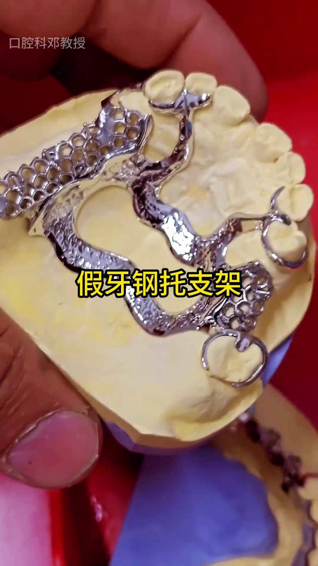 各式各样的假牙钢托支架口腔科普 假牙 口腔科邓教授