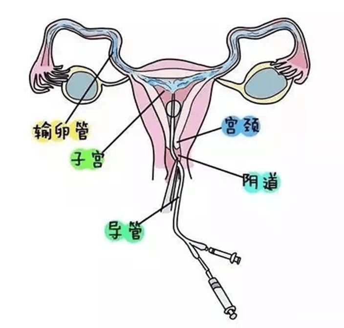一文读懂输卵管造影