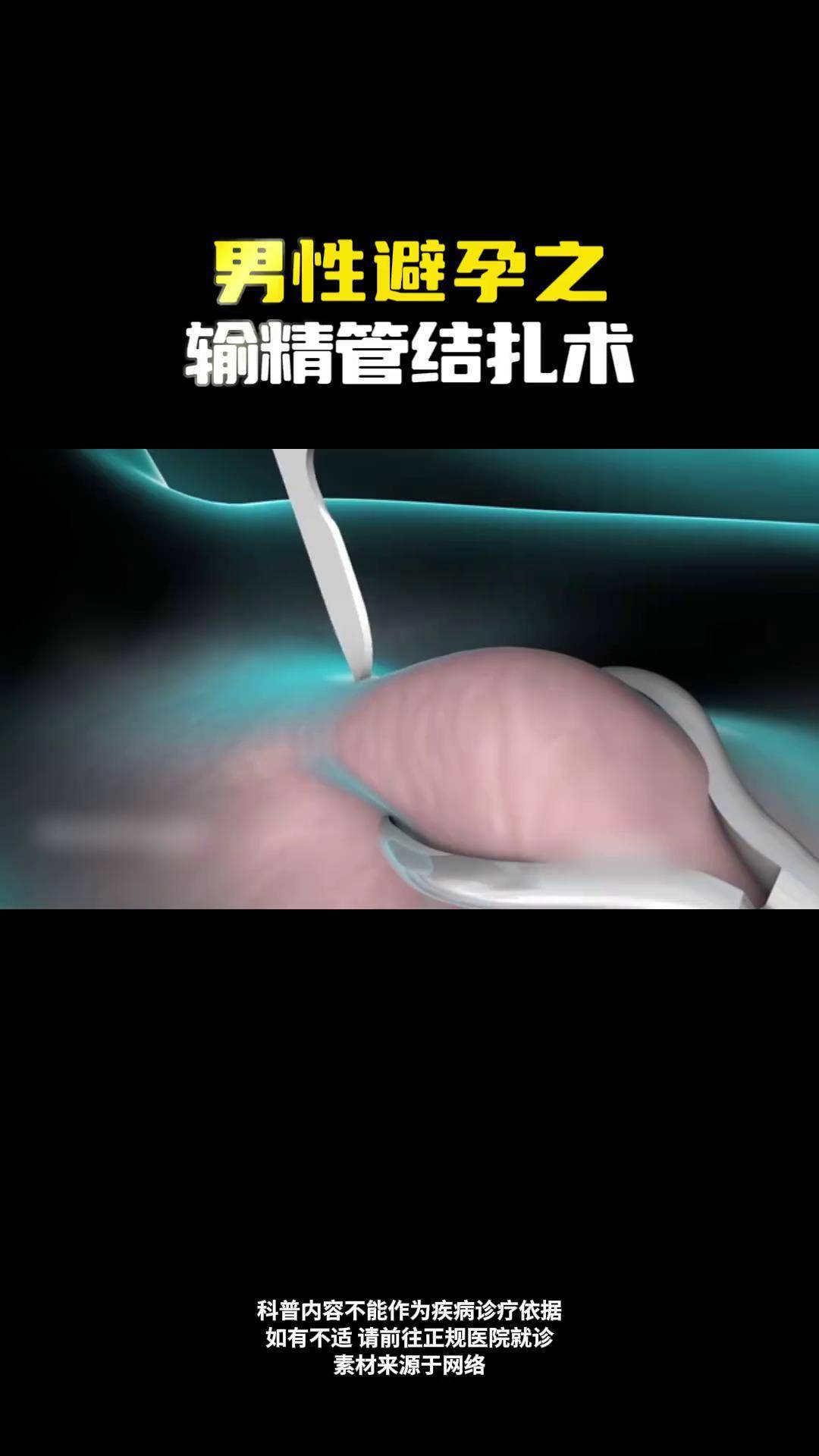 男性避孕之输精管结扎术 科普 男性