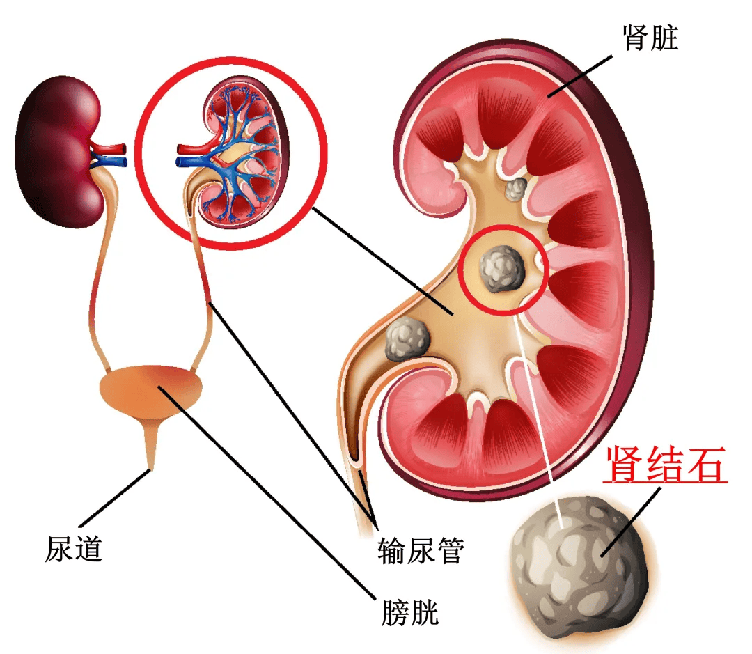 去医院被诊断出双肾有结石,其中左肾结石卡在了输尿管入口