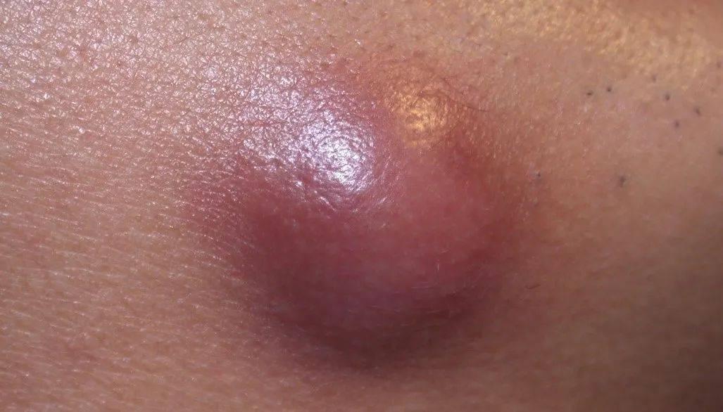 口腔_连文海_冠周炎