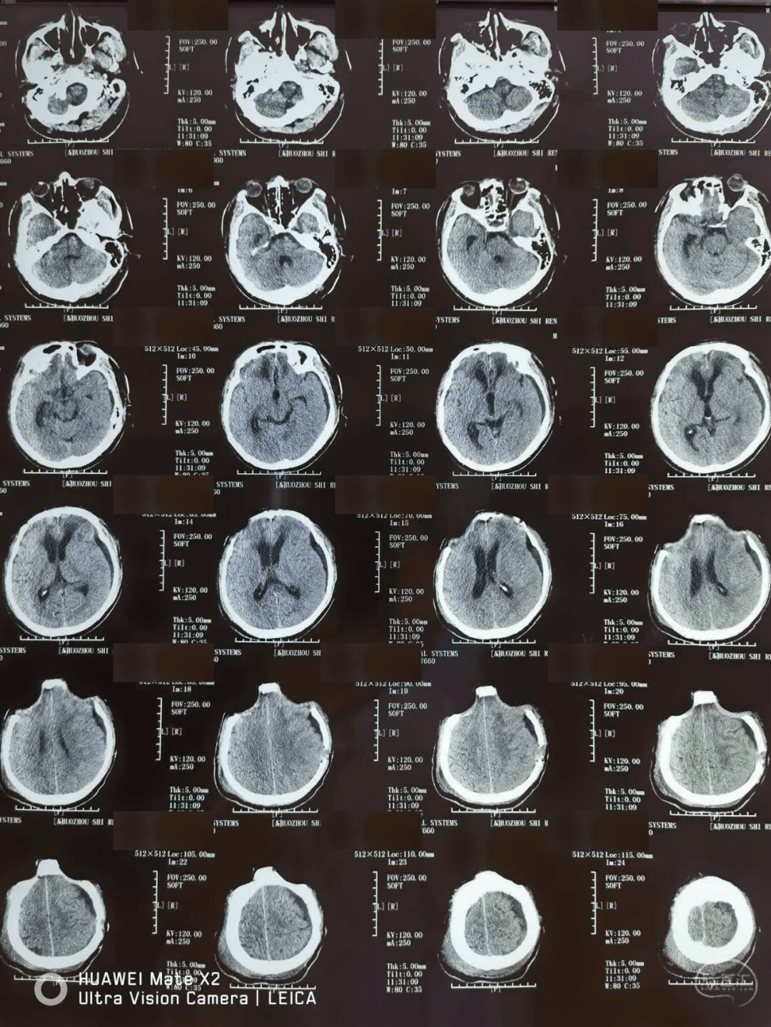 7月31日拔除引流管,8月1日ct如下:7月28日ct,引流减少,夹闭引流管