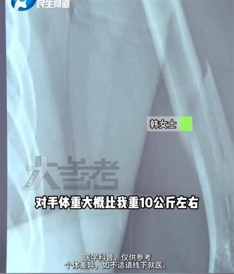 27岁女子参加掰手腕比赛，“咔嚓”一声手臂断了！医生：与对手强弱无关