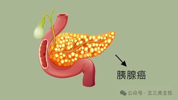 中医经方为胰腺癌治疗带来新希望 探秘治疗胰腺癌的5大经方