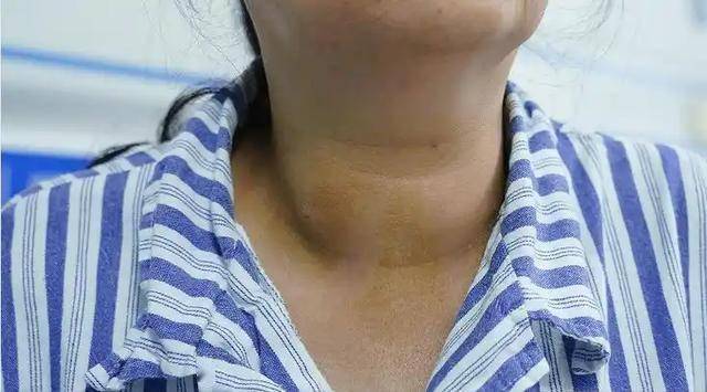破解甲状腺结节饮食密码，守护健康防线 甲状腺结节患者的饮食“红绿灯”，你了解吗？