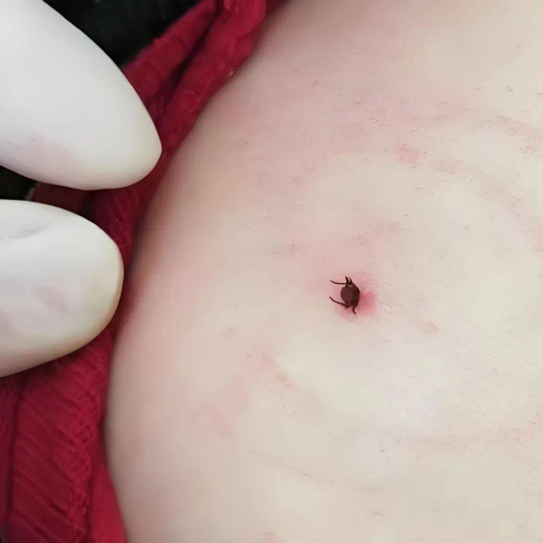 蓬莱疾控:踏青归来身上有红疹?警惕蜱虫的"隐形攻击"