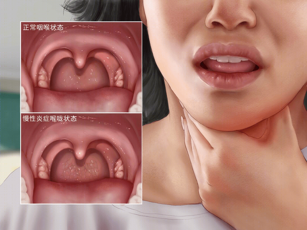 1,多喝水可以立刻喝一大口水,慢慢吞咽缓解不适感.2,反复吞咽做