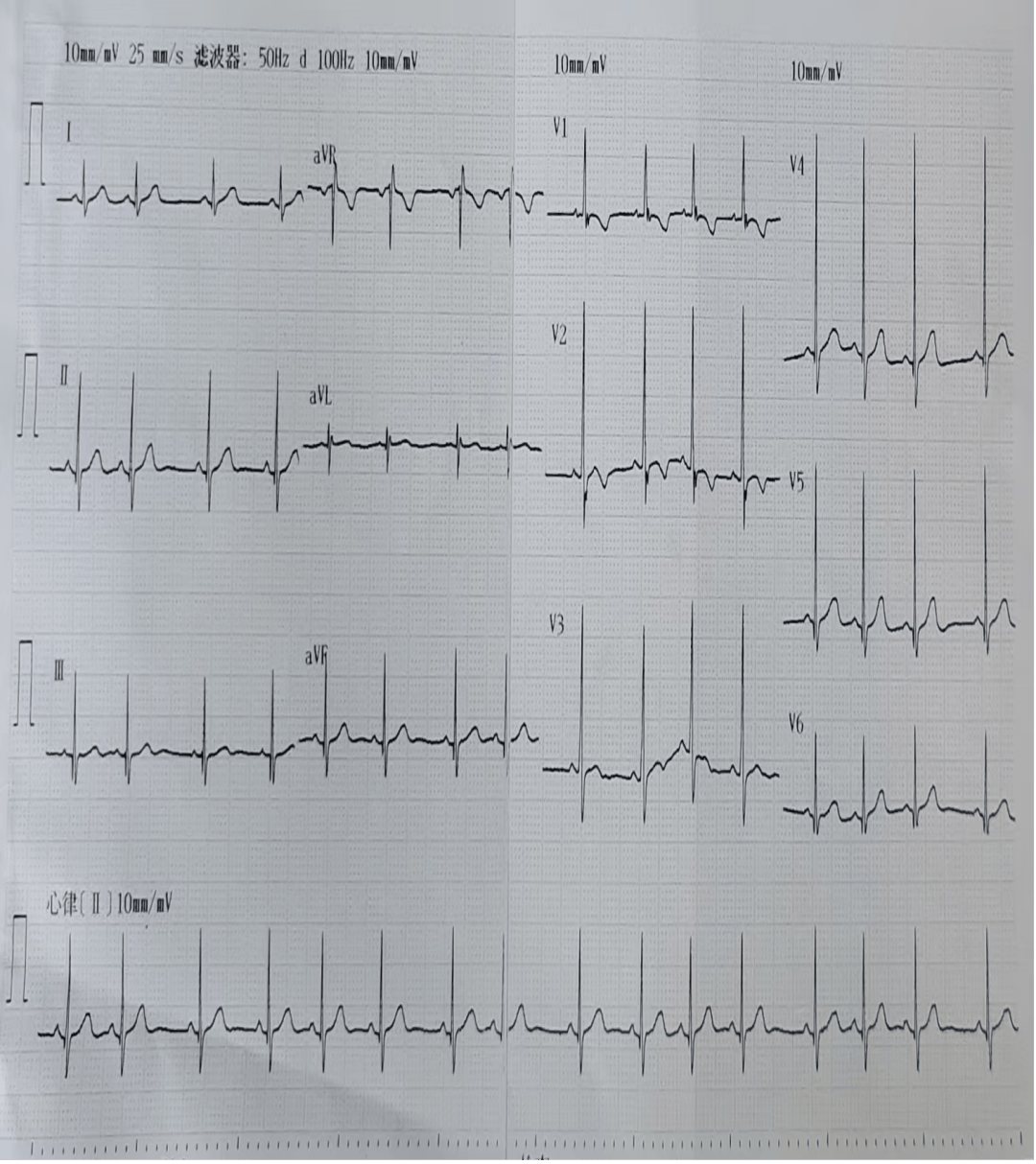 科普 | 儿童窦性心律不齐:家长需要了解的科学知识