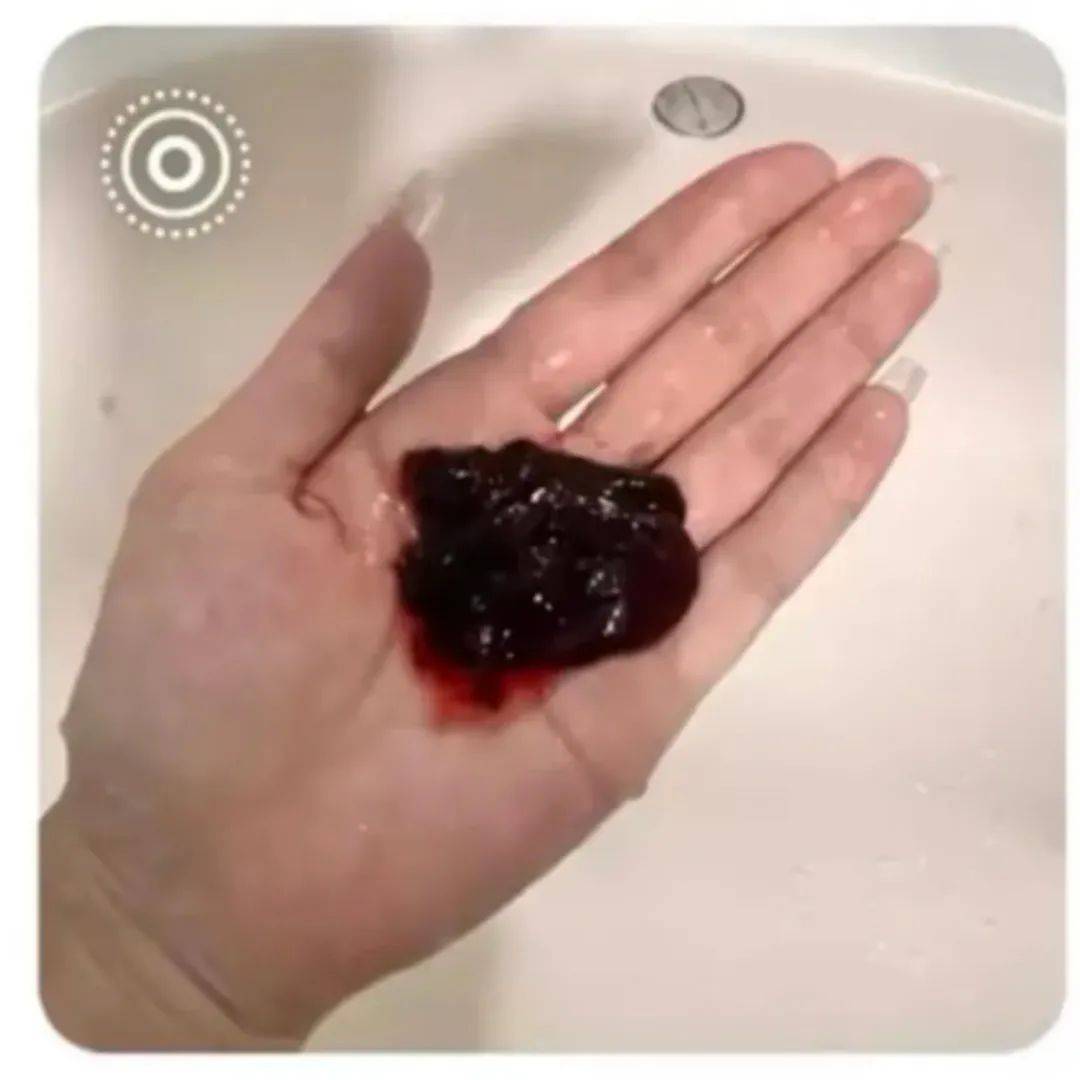 月经掉出超大血块，千万警惕 1 种情况