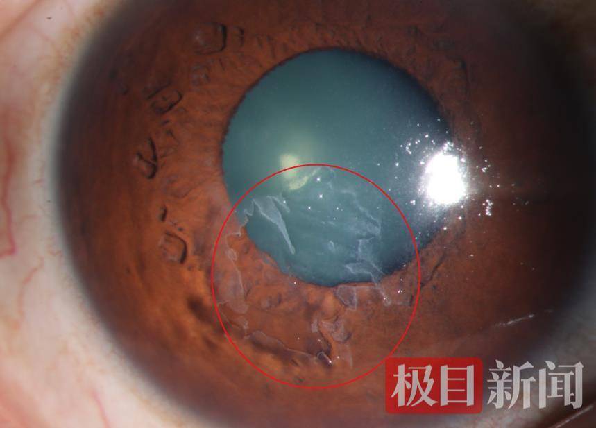 梧桐絮飞入眼,女子角膜破了层皮