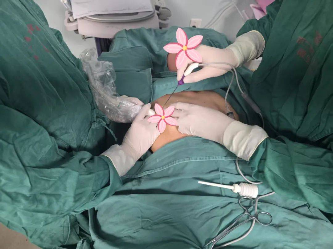 我院乳腺肿物射频消融术,微创无痕,日间手术即搞定!