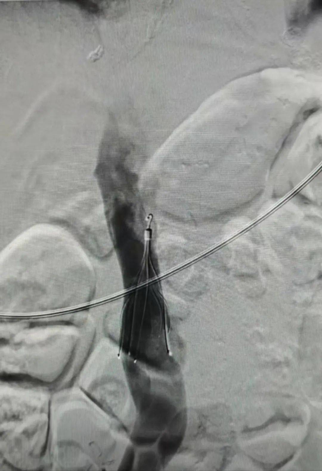 科室动态丨放射诊断科常态开展下腔静脉滤器置入术