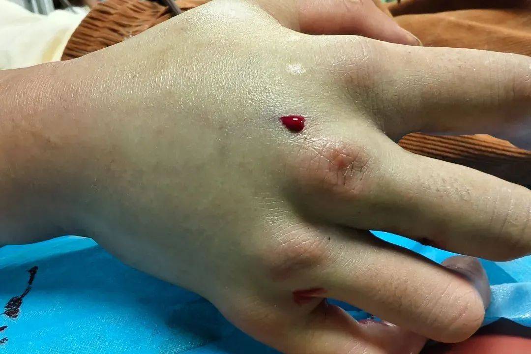 重庆一男子被五步蛇咬伤住进重症监护室!转扩!救命用! 重庆一男子被五步蛇咬伤住进重症监护室!转扩!救命用!