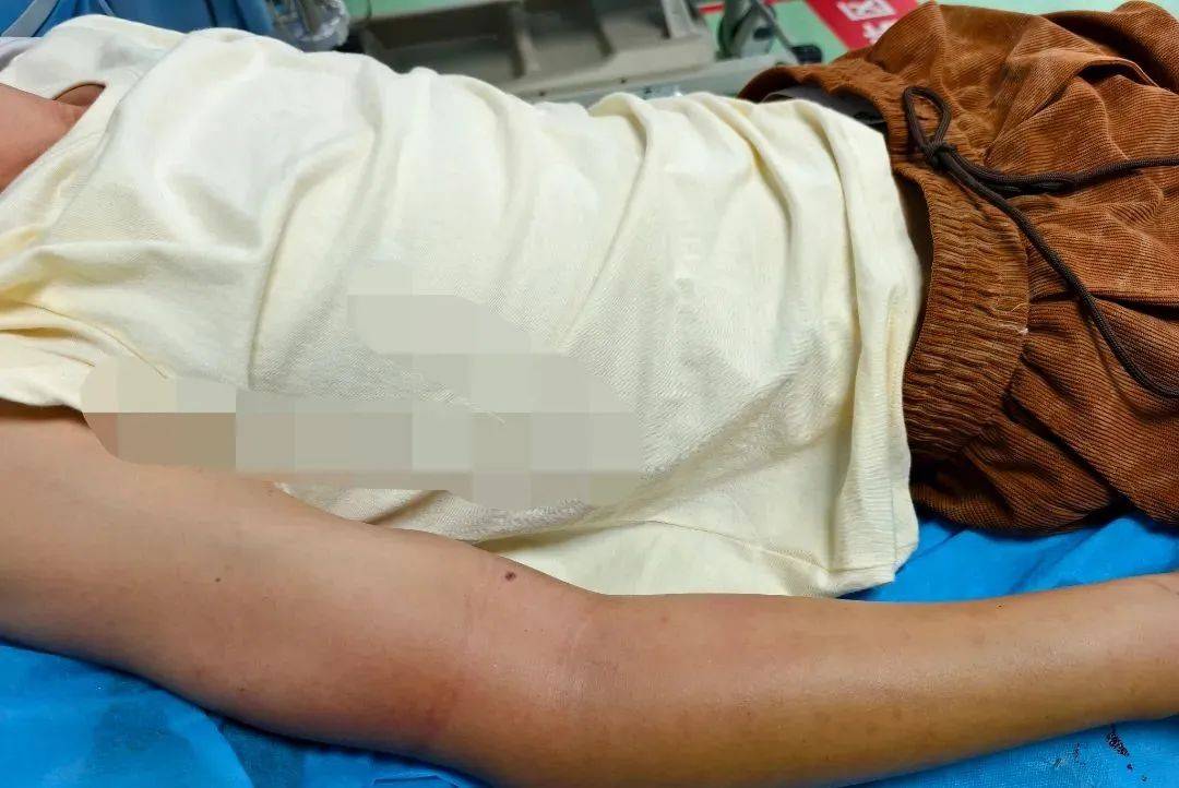 重庆一男子被五步蛇咬伤住进重症监护室！转扩！救命用！