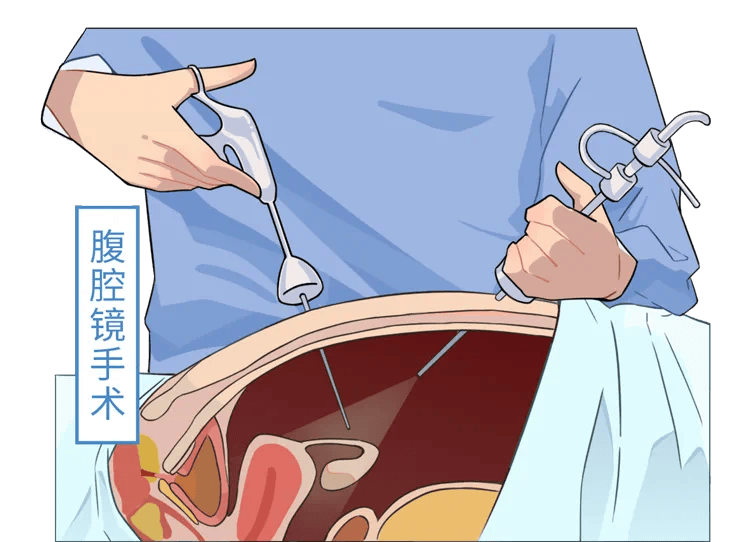 微创子宫切除术_杭州市一医院产科好吗_子宫腺肌症治疗