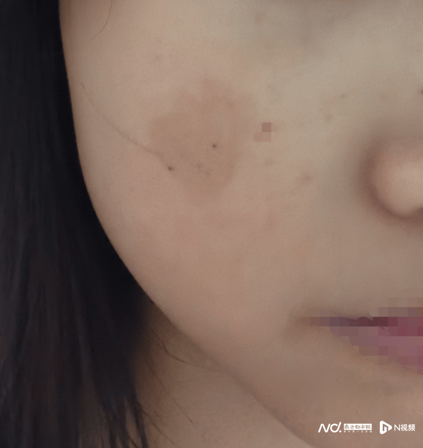女子在深圳龙岗中心医院整形后留明显疤痕 院方:正常并发症(图1)