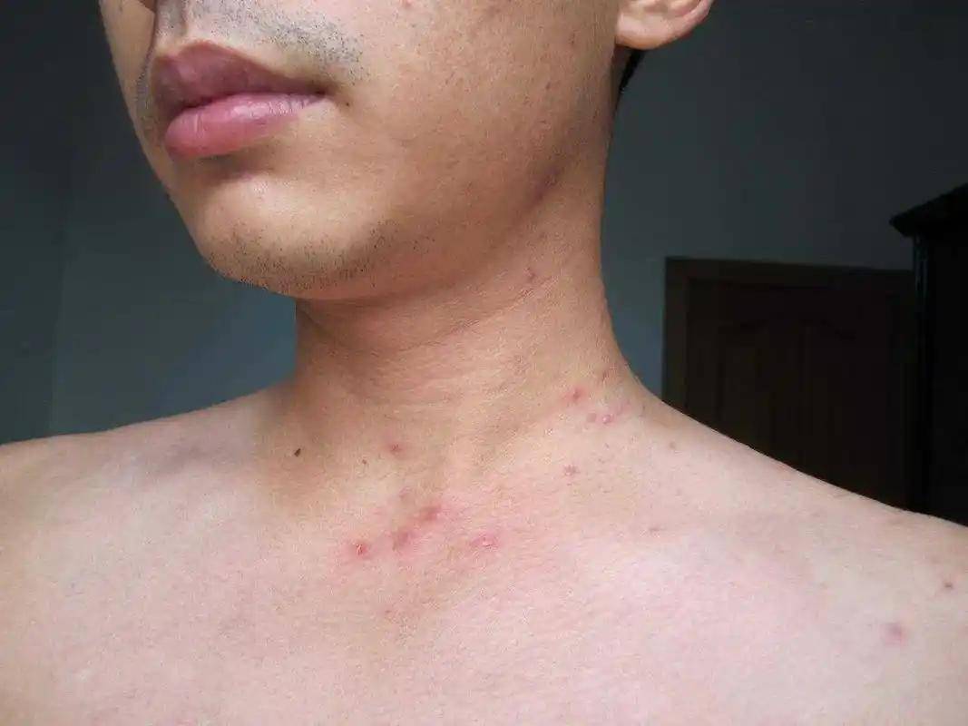  疫情的症状表现有哪些呢(疫情的症状是怎么样的)