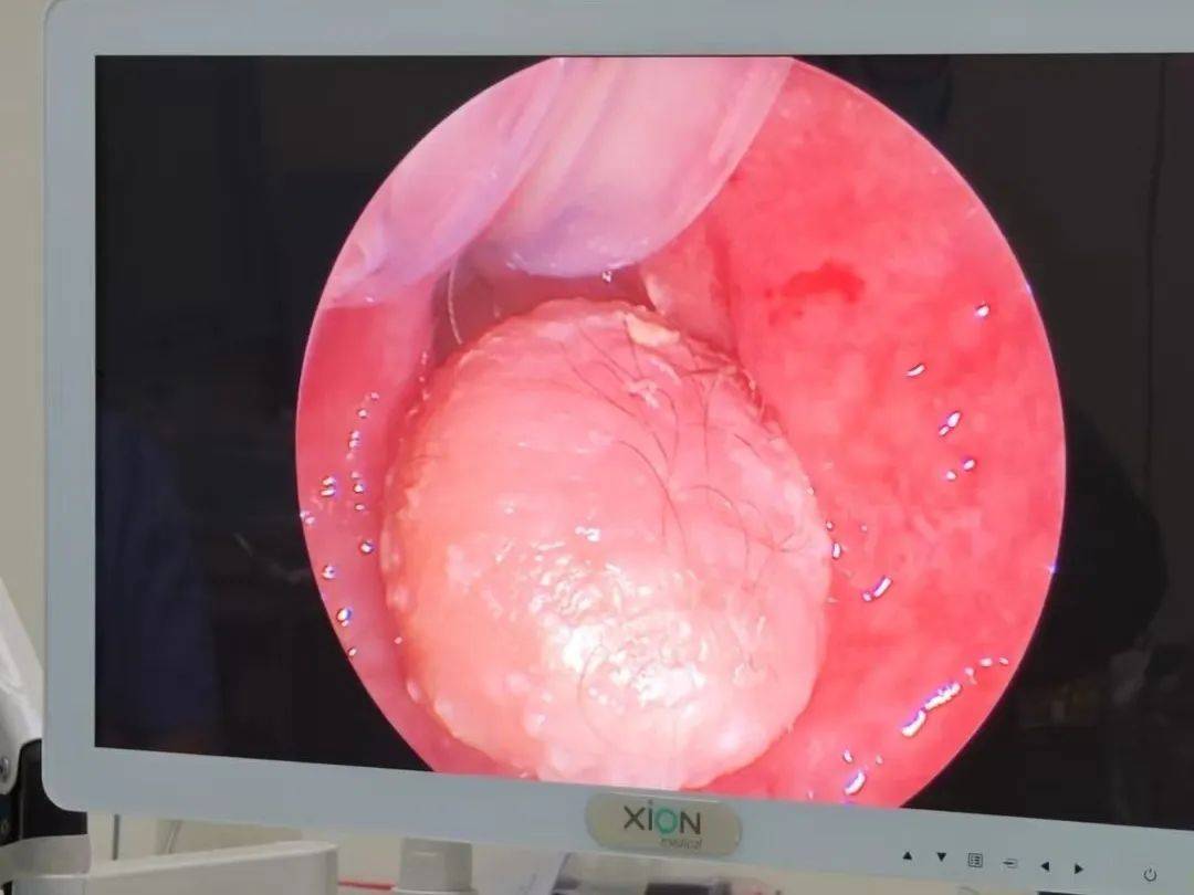 6月龄宝宝左耳道流脓4月余,竟从鼻腔揪出个"小肉球"?