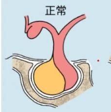 别被名字吓到!一文了解“空泡蝶鞍”_垂体_empty_sella