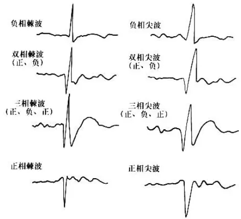 脑电图的 "正常" 与 "异常":波形特征及判断标准