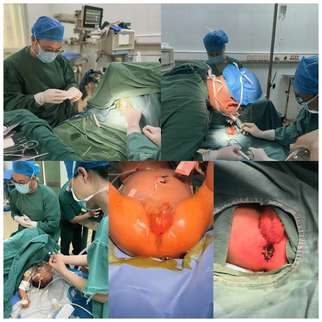 市榕城区妇幼保健院为新生儿"解锁"--肛门成形术