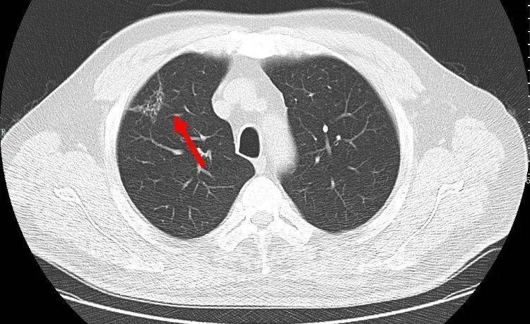 厦门男子十年来反复咳嗽发烧，以为是肺炎，结果却令他崩溃：变成了肺癌！_刘先生_病灶_右肺