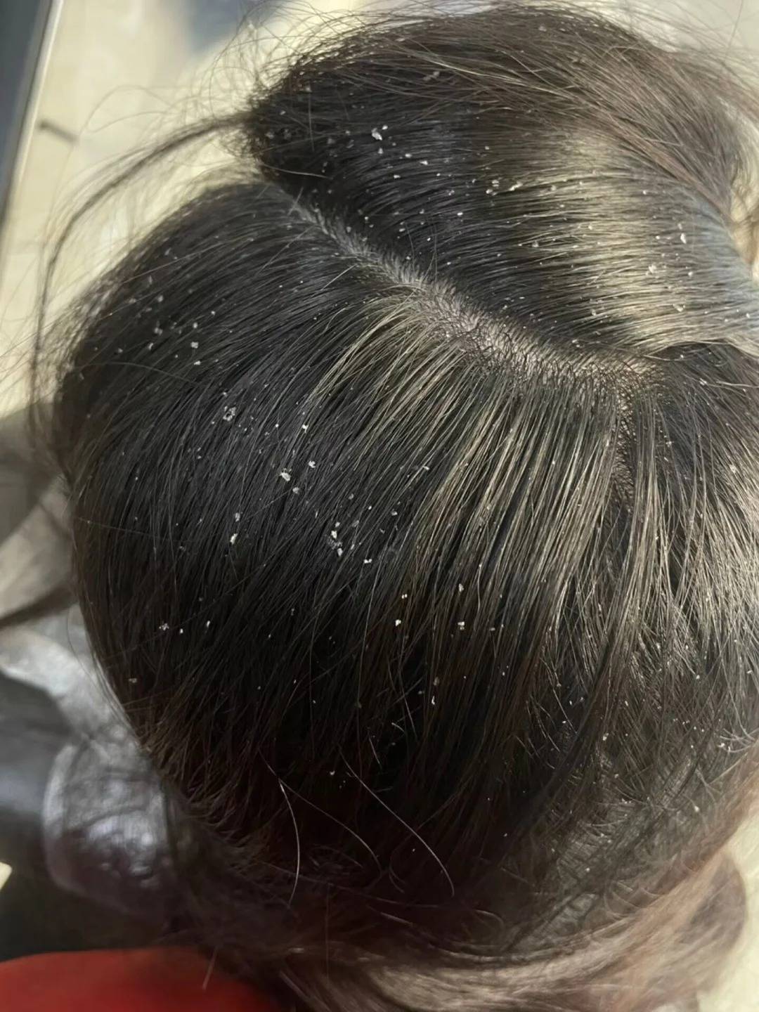 控油去屑洗发水排名?解决头油头屑脱发难题