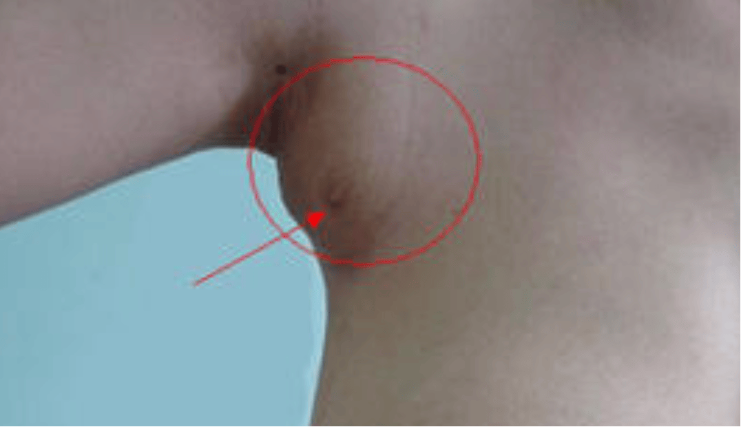 怀孕后长副乳怎么回事？关于副乳的真相