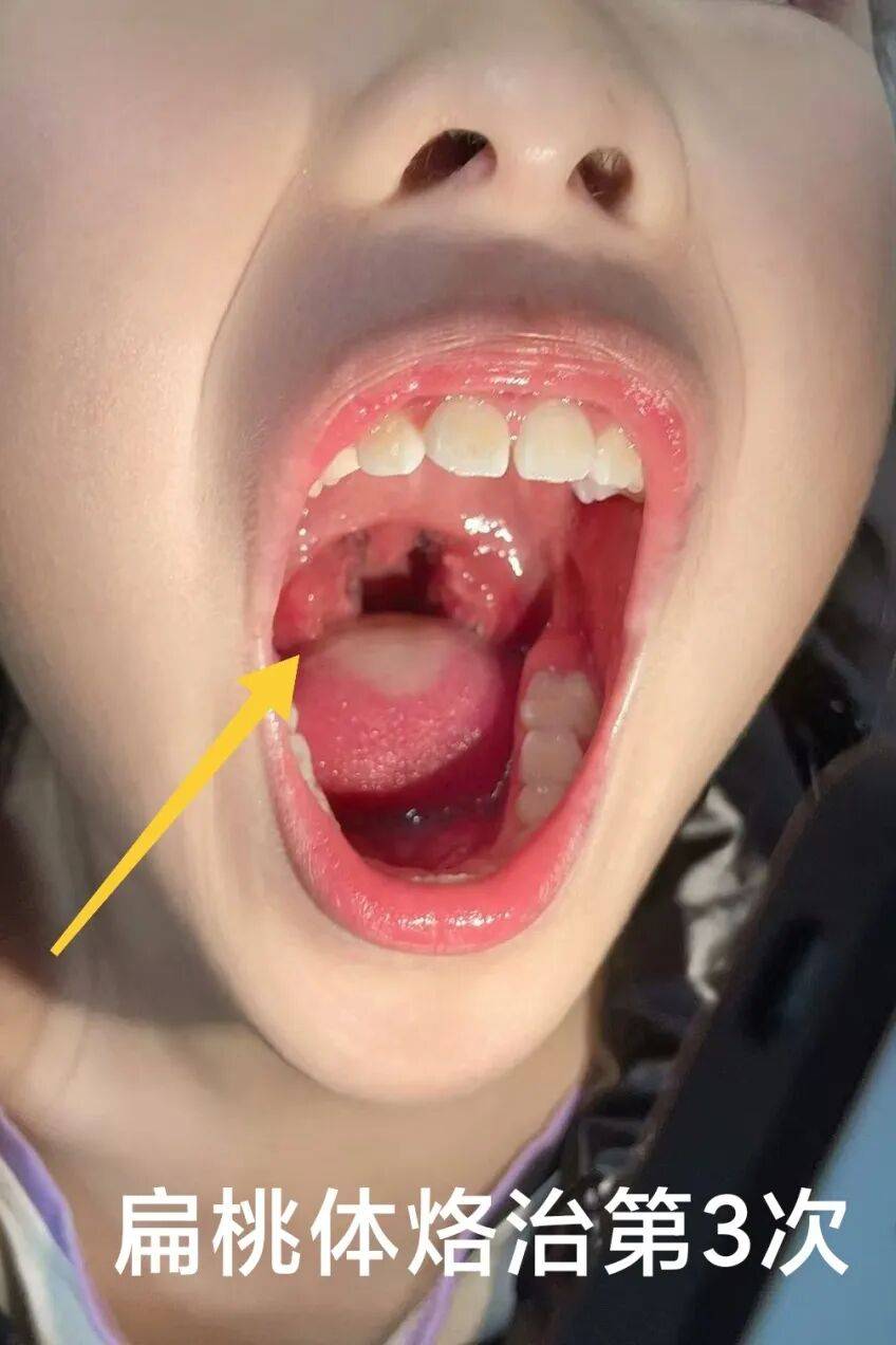 就扁桃体红肿化脓自己一遇换季,劳累