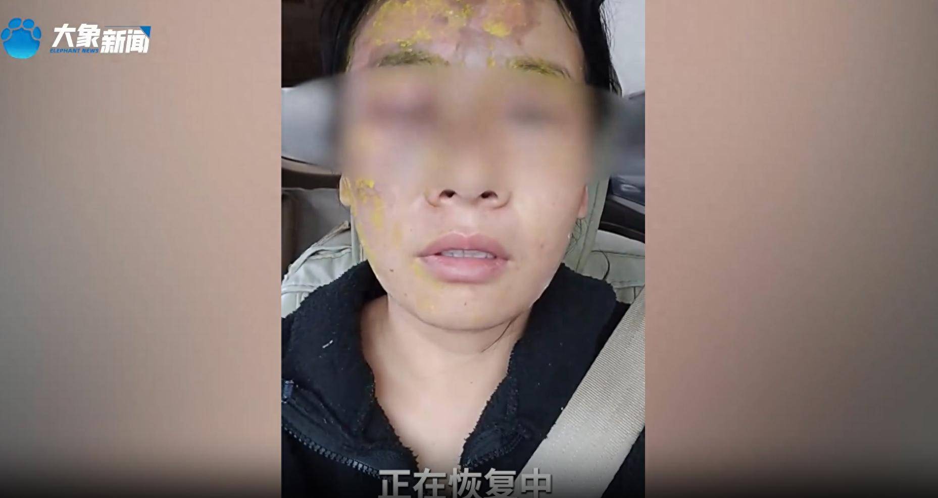 女子模仿网络“妙招”用白醋、白糖等除水垢，近距离看去除效果时壶内沸水突然炸开，致面部烫伤