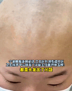 14岁女孩竟然全秃了？医生：这些习惯一定要改