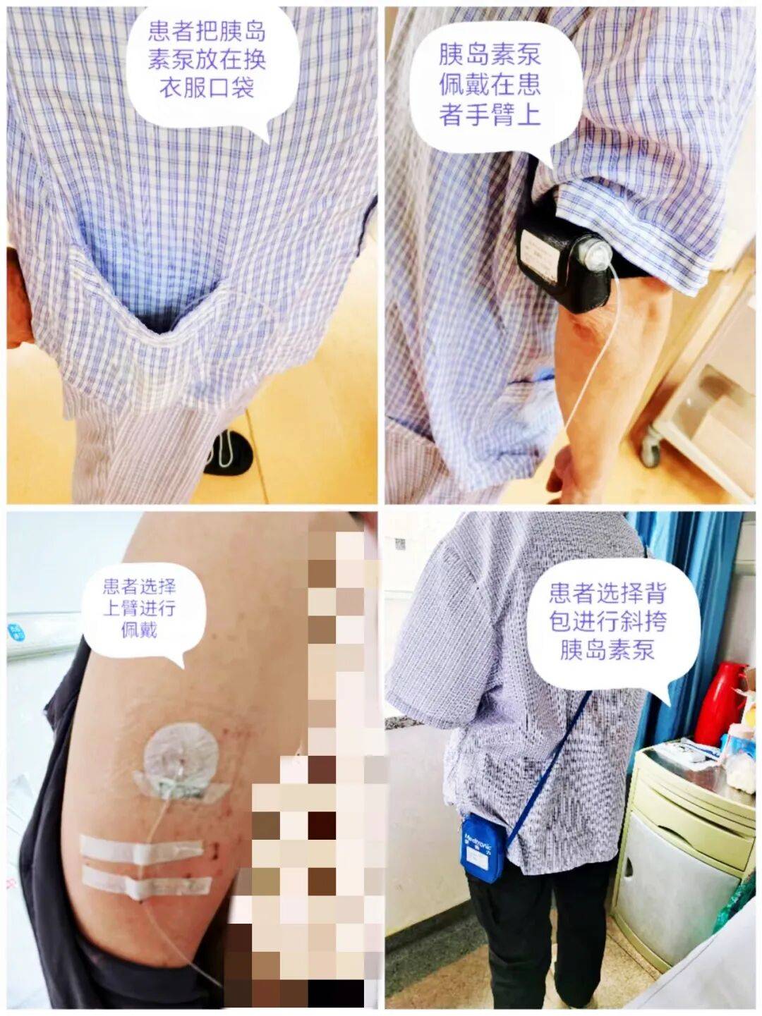 过去护士为患者佩戴胰岛素泵时常习惯性选择腹部位置将胰岛素器