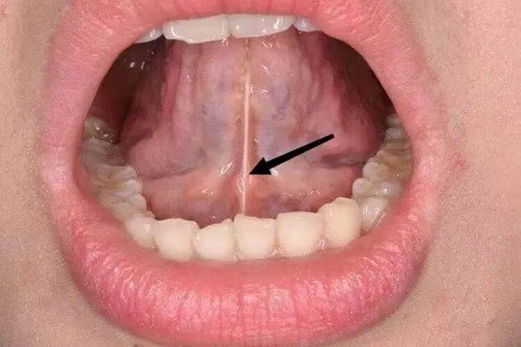 解开"舌尖上的束缚":正确认识舌系带短缩