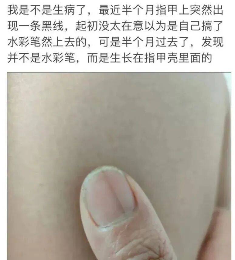 指甲出现这个变化,可能是癌变! 指甲出现这个变化,可能是癌变!