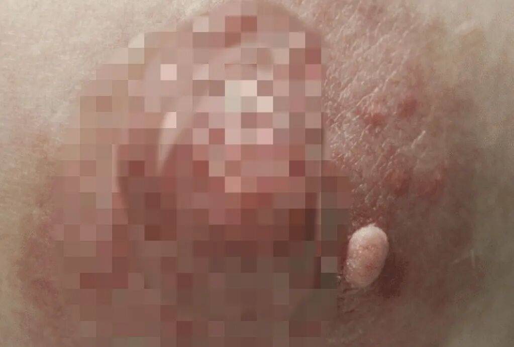 乳房上长小肉粒可能是HPV感染,小心传给孩子