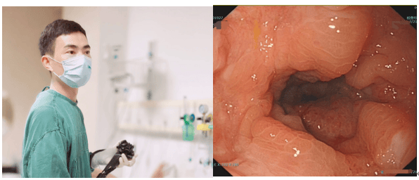 肠道印戒细胞癌：躲藏在直肠里的「指环王」