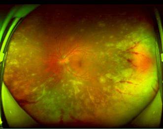 【佑安服务】分秒必争，北京佑安医院打通急性视网膜坏死（ARN）绿色通道为视力保驾护航