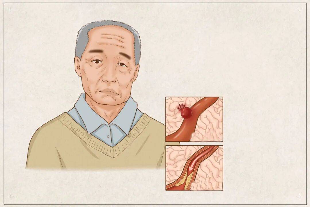 远离脑卒中 记住这几点