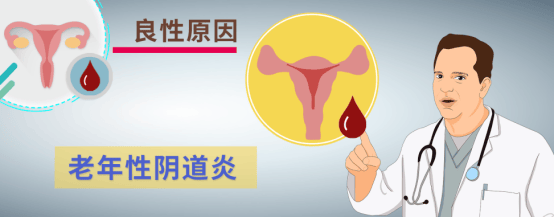 绝经后出血并非“返老还童”，千万别大意！