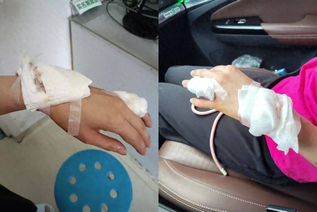 消费者称大窑玻璃瓶静置时突然爆裂致肌腱损伤 接受缝合手术(图1) 文章配图-1