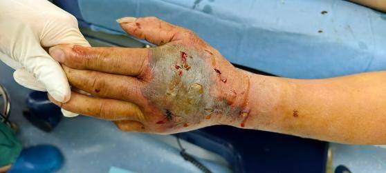 72岁大爷杀死剧毒眼镜蛇 5分钟后离断蛇头突然“复仇”毒牙狠狠刺入其掌心